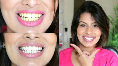 Teeth Whitening