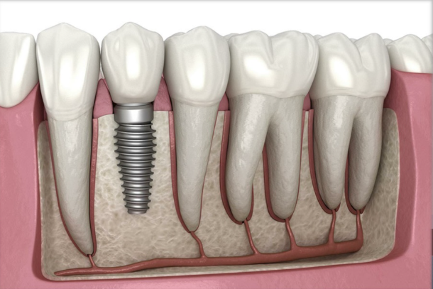 Dental Implants