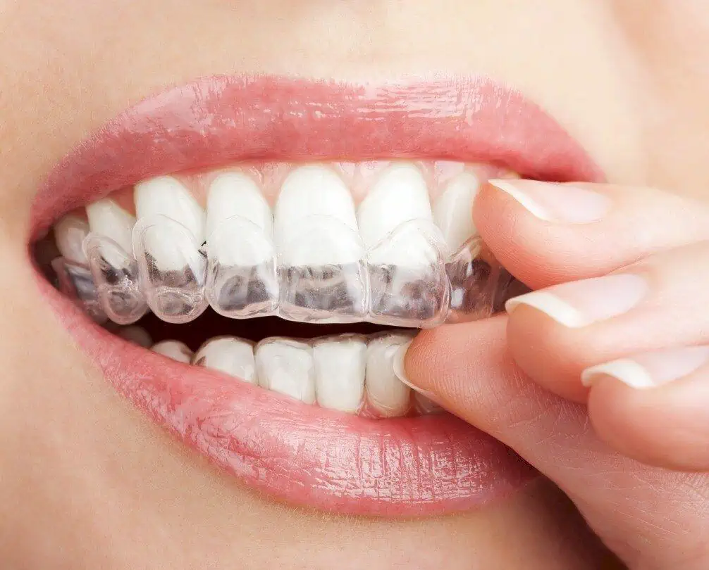 Braces & Aligners