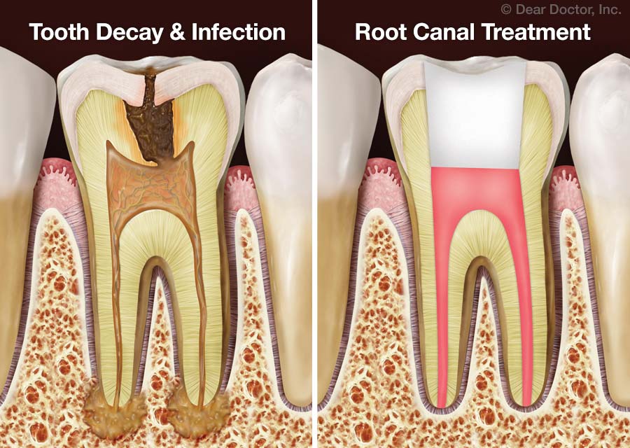 Root Canal