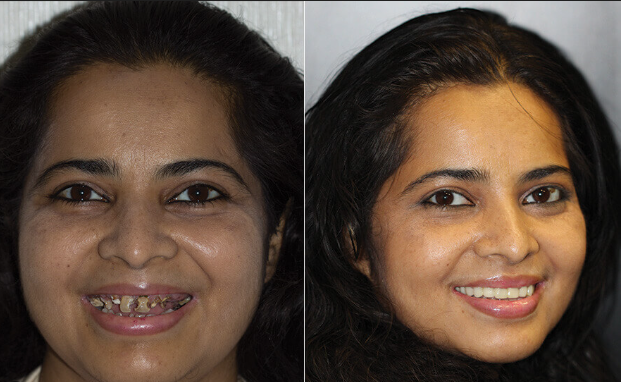 Before and after smile transformation