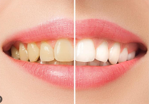Professional teeth whitening results